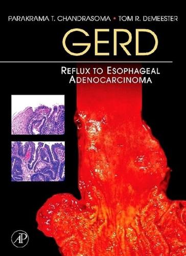GERD Reflux to Esophageal Adenocarcinoma